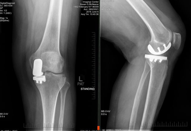 SGM Left Knee