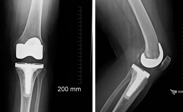 Left knee