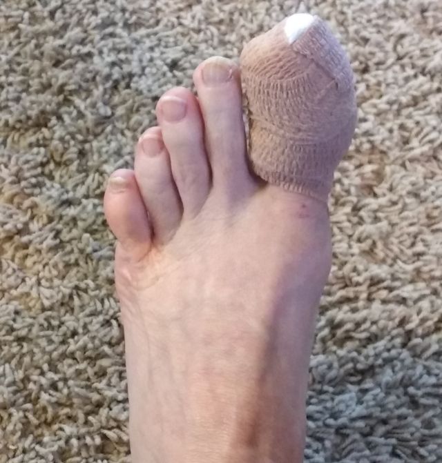 Ingrown toenail