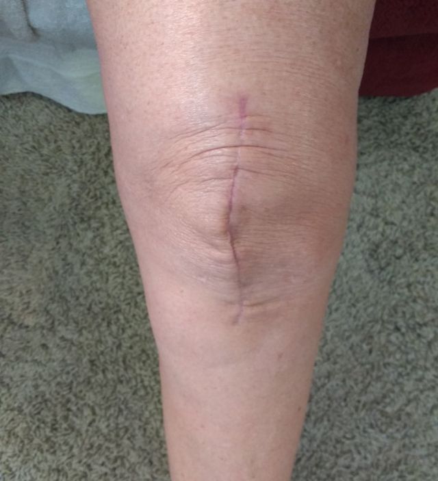 Left knee