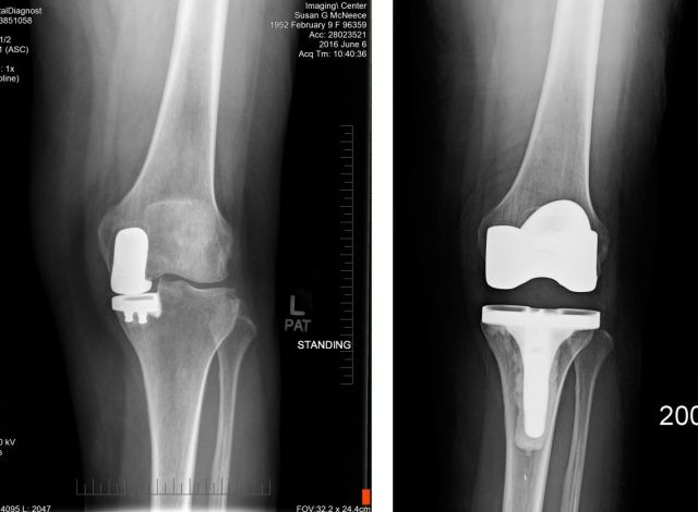 Front--partial vs full