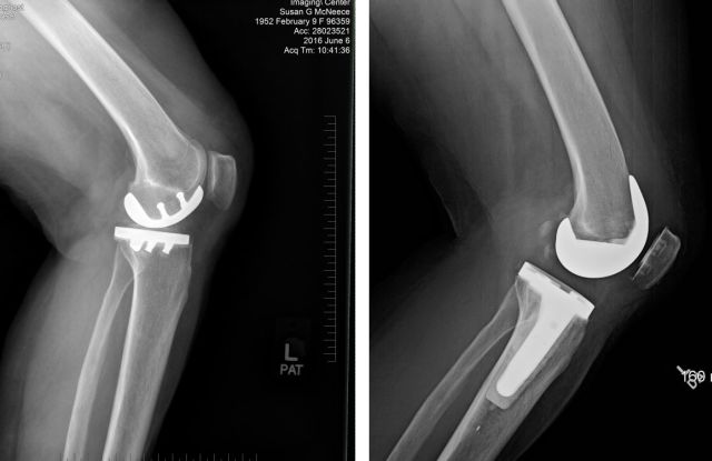 Side--partial vs full