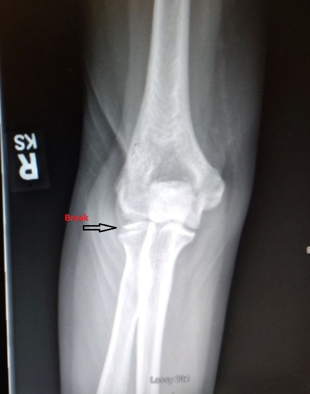 Elbow