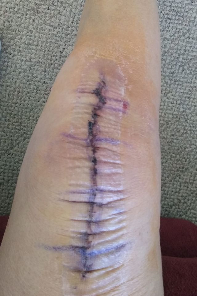 Inner bandage