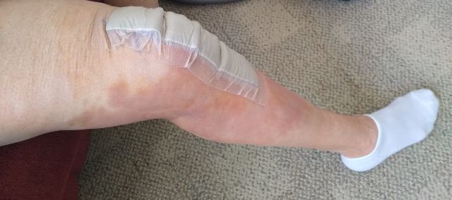 Outer bandage