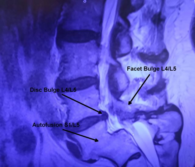 Spine MRI