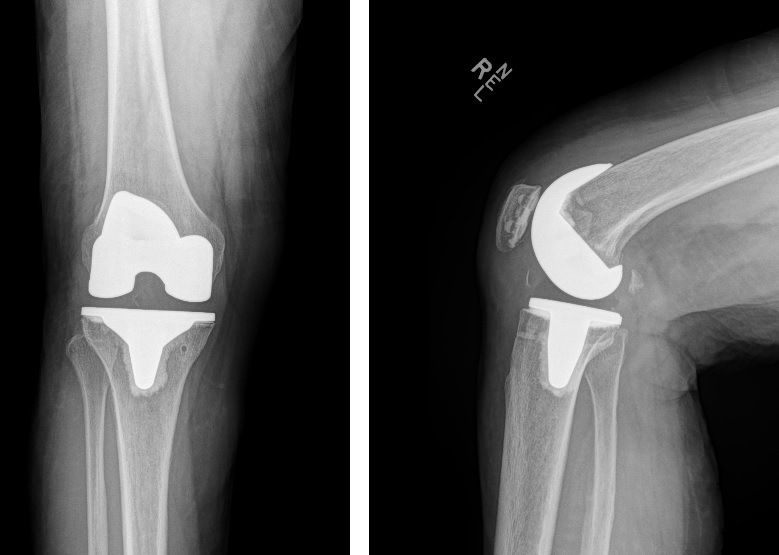 Right knee xray