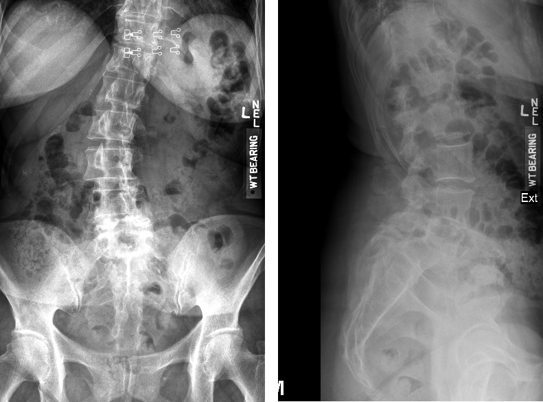 Back xray